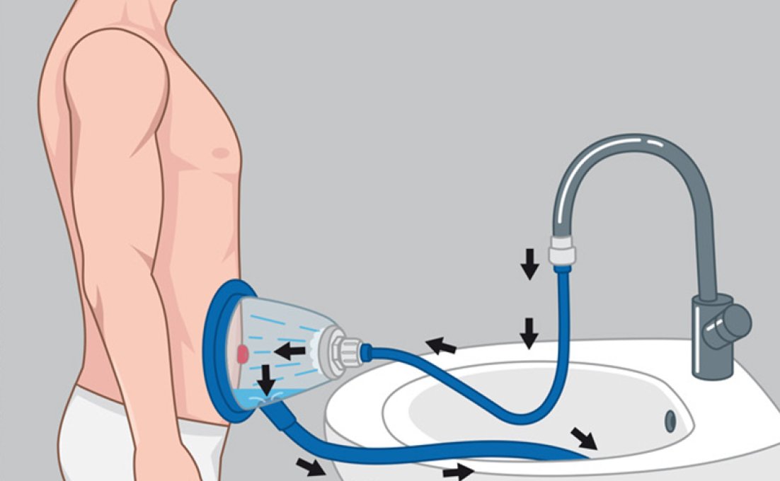 Schema werking van de stomadouche